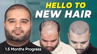 Hair Transplant in Jaipur | Best Results & Cost of Hair Transplant in Jaipur