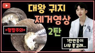 귀지/귓밥/귀똥 제거영상 2탄ㅣ귀파면 안되는 이유 (식사 전에는 보지마세요..)ear wax removal