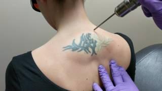 Laser Tattoo Removal | DermMedica