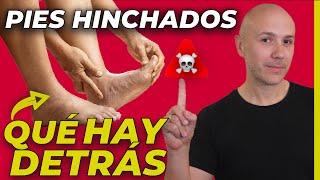 ATENCIÓN CON LOS PIES HINCHADOS PUEDES ESTAR EN RIESGO DE ESTO | RETENCIÓN DE LÍQUIDO Y EDEMAS CAUSA