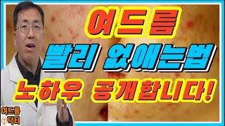 여드름 빨리 없애는법! 노하우 공개합니다!