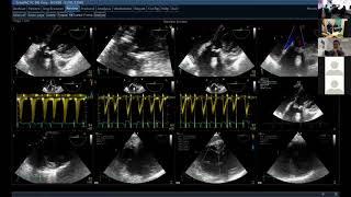 Cardiac Masses
