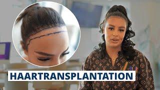 Haartransplantation bei einer Frau: Jahy.C zweite Haarverpflanzung