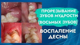 Зубы мудрости. 8 зубы. Прорезывание. Воспаление десны.