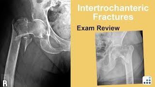 Intertrochanteric Fractures Exam Review - Bohannon Mason, MD