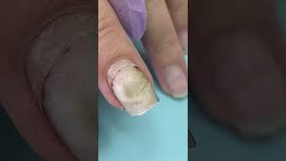 What Happened After Using Nail Glue