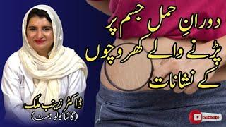 How to prevent and treat stretch marks during pregnancy | Expert Advice from Dr. Zainab Malik