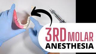 AN EFFECTIVE APPROACH TO BOOSTING THIRD MOLAR ANESTHESIA | OnlineExodontia.com