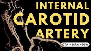 Internal Carotid Artery Segments and Branches | Radiology anatomy part 1 prep | Angiography