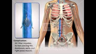 IVC Filter Complications - Medical Animation