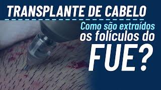 Como é feito o FUE no transplante capilar?