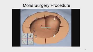 Mohs Micrographic Technique -  An Overview