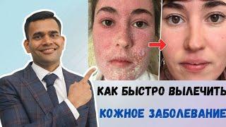 Как Быстро Вылечить Кожное Заболевание