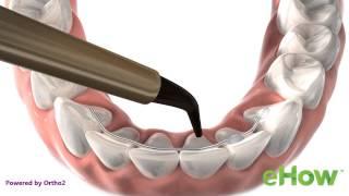 Permanent Retainer