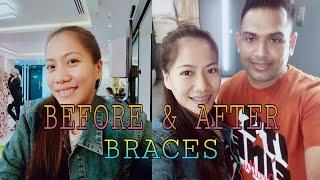 MURANG BRACES SA DUBAI |  Bella Viso Medical Center| Muck & Mary