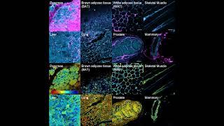 Researchers image live drug response and resistant 'pockets' in pancreatic cancer