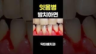 잇몸피 계속나는데 방치하는경우 큰일납니다 #부산잇몸치료