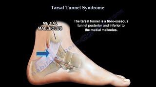 Tarsal Tunnel Syndrome, causes and treatment.