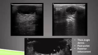 Ultrasound of Skin and Soft Tissue Infections