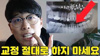 방학 때 교정 계획 중인 분들 반드시 시청하세요! 교정기 후기