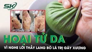 Hoại tử da  vì nghe lời thầy lang bó lá trị gãy xương | SKĐS