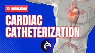 Cardiac Catheterization - 3D Animation