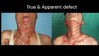 True & Apparent Defect - How to mark!