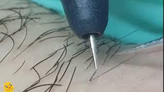 ELECTROEPILATION OF HAIR IN THE BIKINI AREA