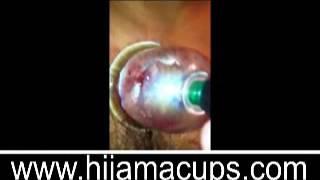 Hijama Lesson 4 الحجامه  Part 1 2 Cupping the Chest