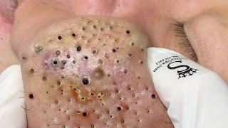 Big Cystic Acne Blackheads Extraction Blackheads & Milia, Whiteheads Removal Pimple Popping # 4589