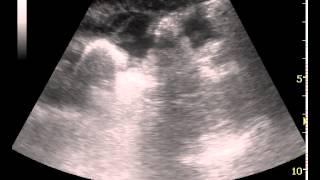 Perforazione di viscere cavo addominale -emergency ultrasound-