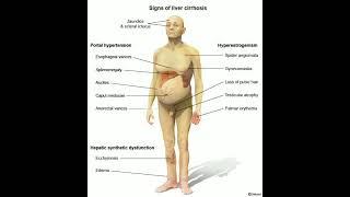 Signs of liver Cirrhosis #heart #liver #cirrhosis #signs
