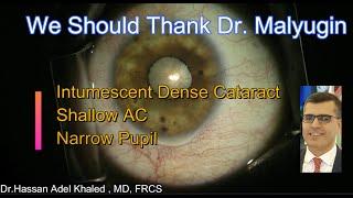 Intumescent Hard Cataract with Narrow Pupil and Shallow AC