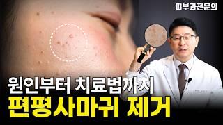 편평사마귀, 방치하시면 안됩니다! 원인부터 치료 방법까지 총정리 (검버섯, 좁쌀여드름과 구별)