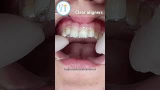 Clear Aligners - This is how you put them #aligner #dentist #dental #teeth #clearaligners