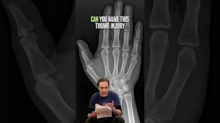 Why This Painful Thumb Injury Is OFTEN Missed⁉️