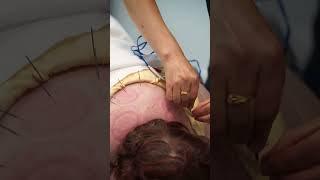Neck Pain Treatment with Acupuncture @beyondphysiotherapy3123  #acupuncture #Physiotherapy #Surrey