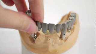 K Dental Lab-Implant-1.mov