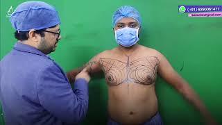 Grade - 2B Gynecomastia surgery || Male breast Reduction || Dr. Jayanta Bain plastic surgeon