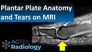 How to Assess Plantar Plate Anatomy and Tears on MRI