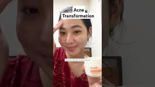 Acne journey credit: polynia.id via IG #acne #acne treatment #acnejourney #pimples