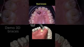 Impacted tooth traction with braces #orthodontist #braces #dentist