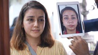 Plastic Surgery for Face Makeover - Beautiful Changes in Face After Surgery!!!