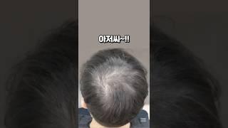 20대 아저씨라고 부르지마요!! #의정부두피문신 #hair #모발이식 #동두천두피문신 #양주두피문신 #연예인탈모 #연예인두피문신#미우새두피문신#두피문신가격