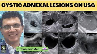 USG Pelvis | Cystic Adnexal Lesions On Ultrasound | SANJEEV MANI | Endometriosis | Ovarian Dermoid