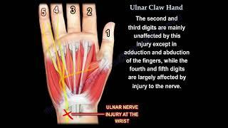 Ulnar Claw Hand Deformity: Diagnosis, Causes, and  Differential Diagnosis.