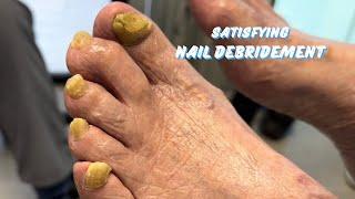 A QUICK AND SATISFYING NAIL DEBRIDEMENT.