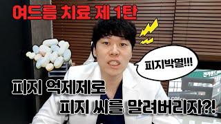 여드름 치료 제 1탄 피지억제제로 피지 씨를 말려버리자?!