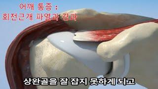 어깨 회전근개 파열과 충돌증후군의 진단과 경과 Diagnosis & Progression of Rotator Cuff Tears & Impingement Syndrome