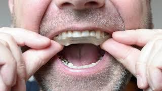 FAQ - What is an Occlusal Splint?